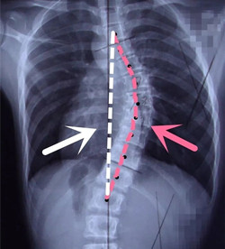 脊柱側(cè)彎后身高會(huì)變短嗎？
