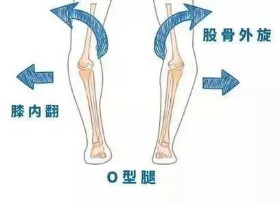 孩子“O”型腿怎么辦？