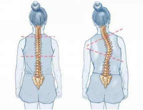 脊柱側(cè)彎的日常預(yù)防