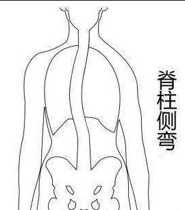 脊柱側彎康復訓練主要從四個方面入手！